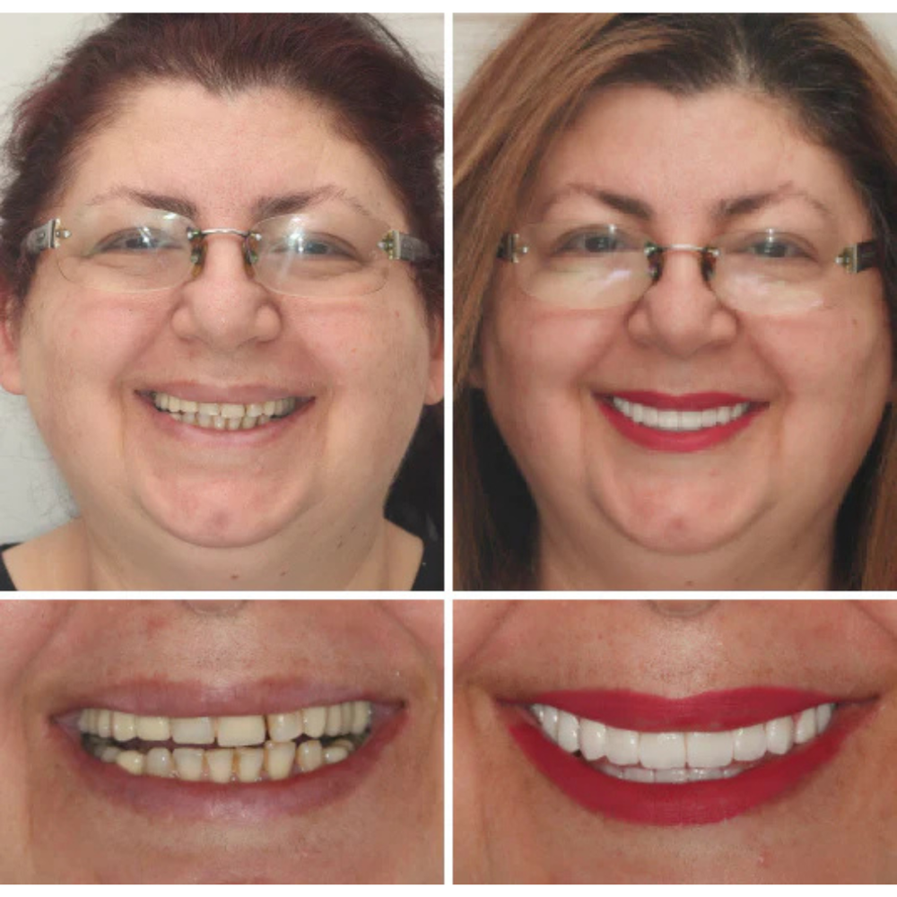 🦷 Advanced Customized Full Denture Set 🔥 10,000+ Sold In Last 30 Day ✨